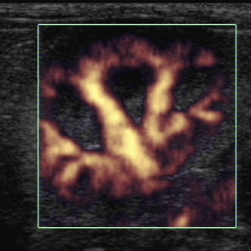 Colour Doppler ultrasound study